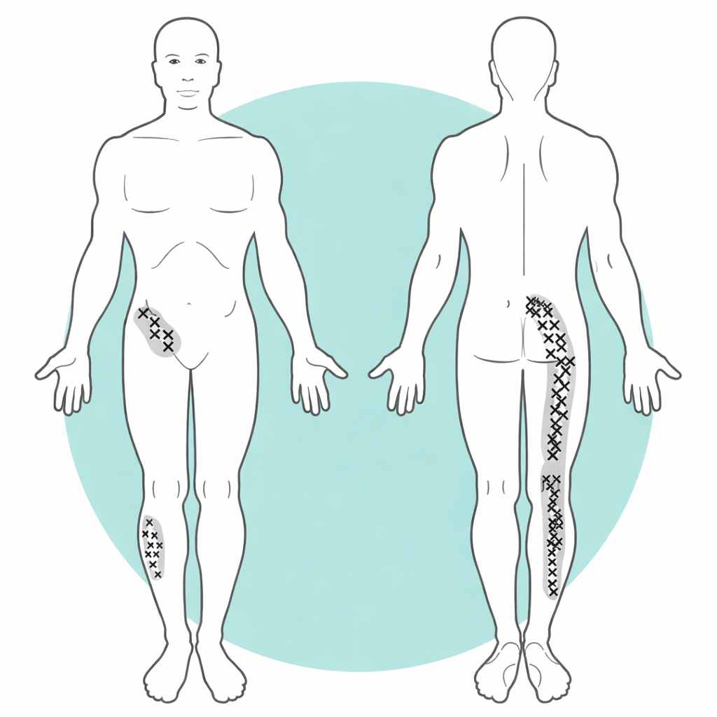Front and back body diagram showing typical sacroiliac joint pain distribution