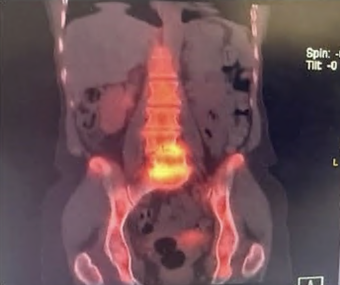 Case 1 follow-up imaging and treatment outcome after endoscopic radiofrequency ablation