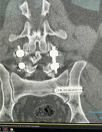 Case 3 CT image showing sacroiliac region instrumentation