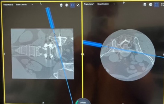 Robotic planning image for revision SIJ surgery in Case 3