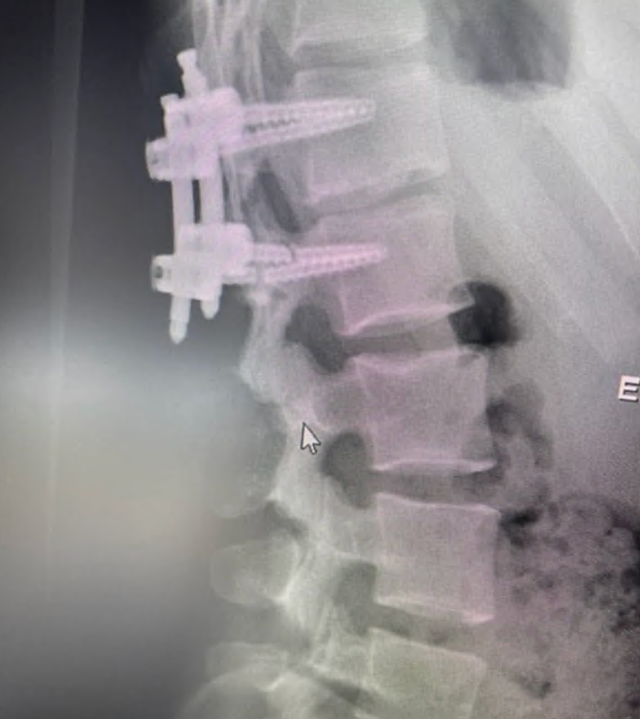 Case 4 radiograph showing hypermobility-related spinal findings