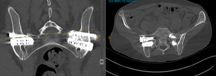 Case 5 CT image showing sacroiliac fixation in a patient with hypermobile EDS